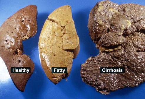 princ_rm_photo_of_liver_examples