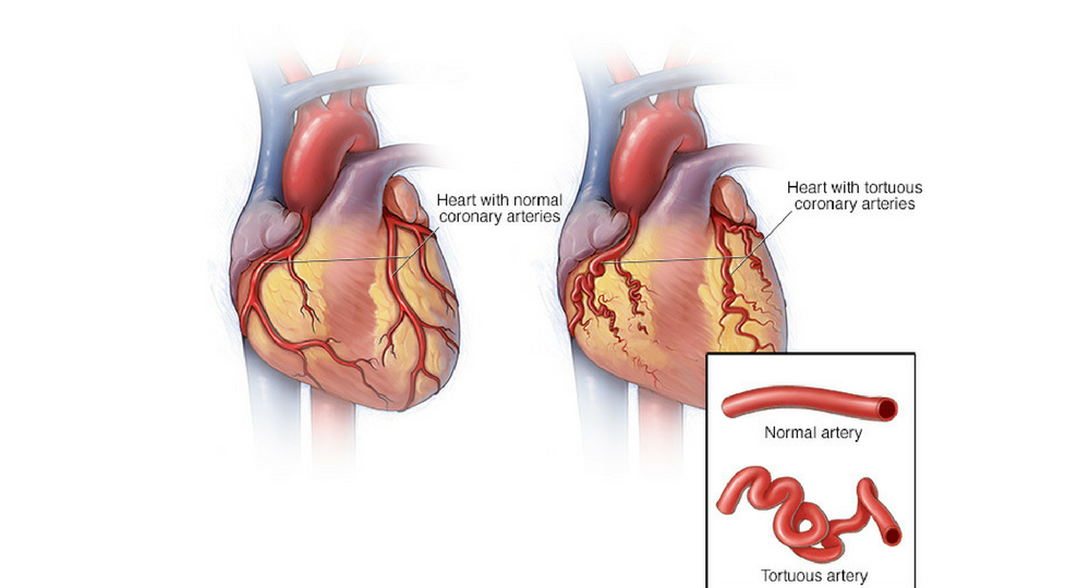 Сужение коронарных сосудов. Стентирование коронарных артерий сердца. Атеросклероз аорты и коронарных артерий.